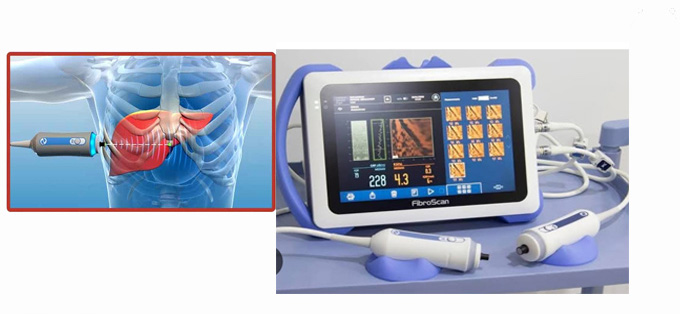 Fibroscan Procedure in Noida